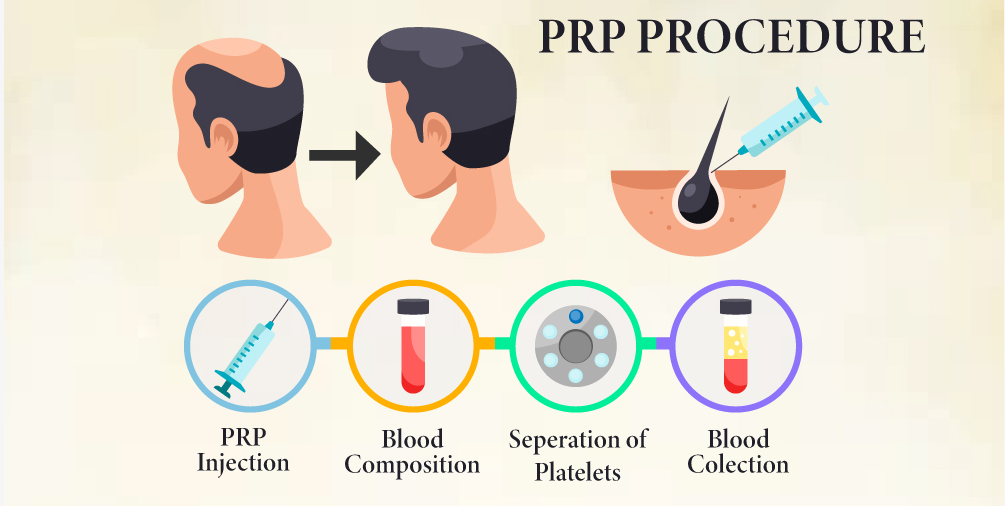 prp_procedure